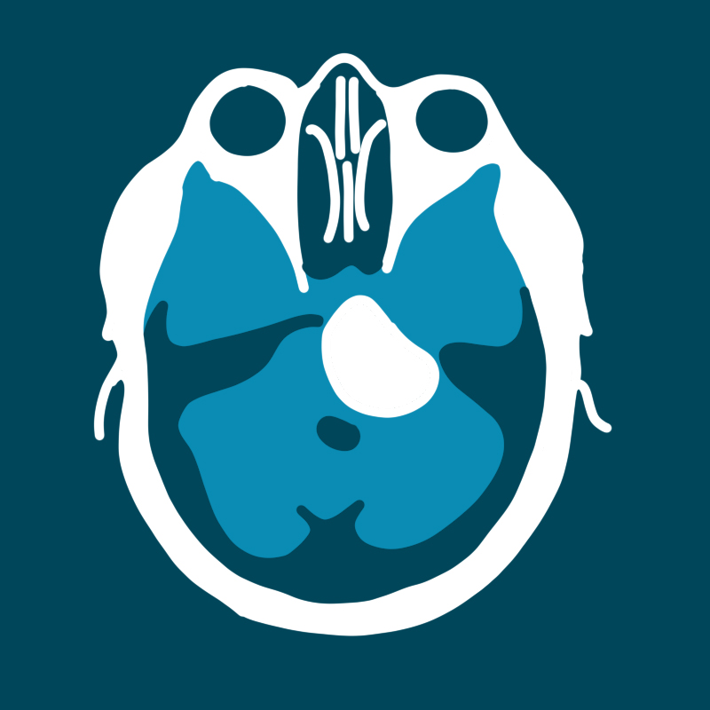 Meningioma - Gruppo Otologico