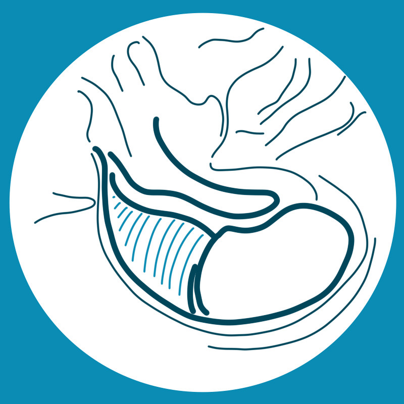 Paraganglioma - Gruppo Otologico